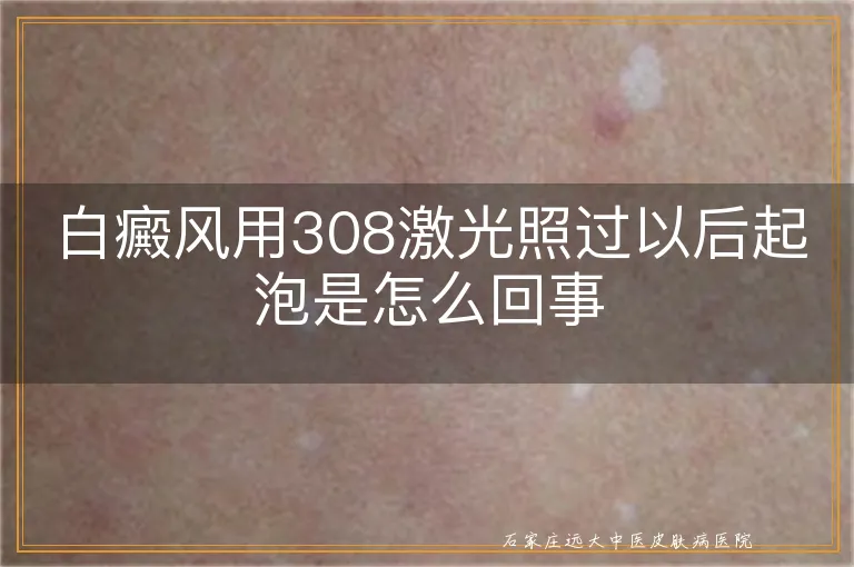 白癜风用308激光照过以后起泡是怎么回事