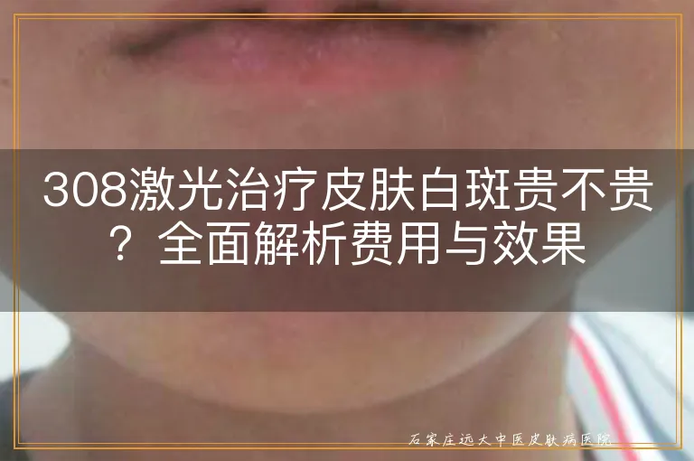 308激光治疗皮肤白斑贵不贵？全面解析费用与效果