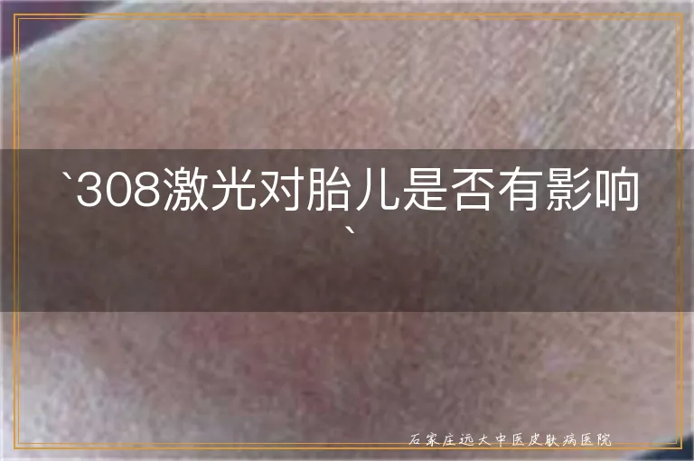 308激光对胎儿是否有影响