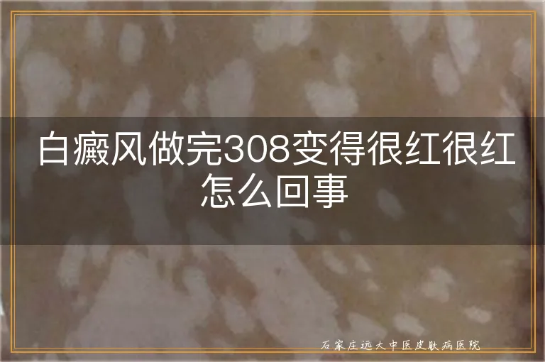 白癜风做完308变得很红很红怎么回事