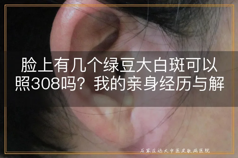 脸上有几个绿豆大白斑可以照308吗？我的亲身经历与解答