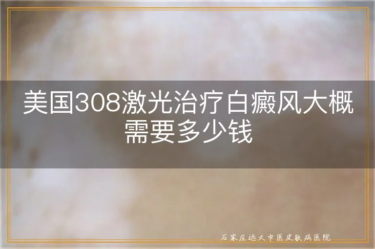 美国308激光治疗白癜风大概需要多少钱