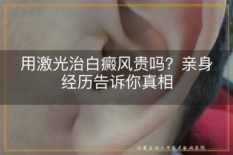 用激光治白癜风贵吗？亲身经历告诉你真相