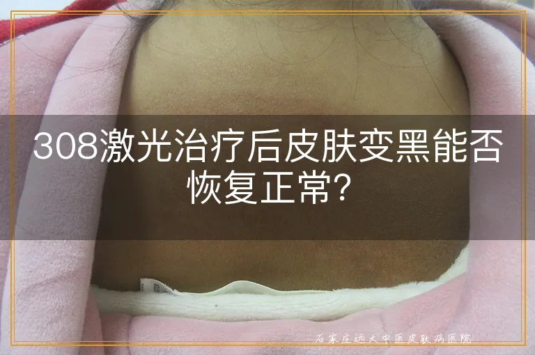 308激光治疗后皮肤变黑能否恢复正常？