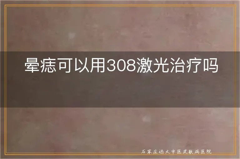 晕痣可以用308激光治疗吗