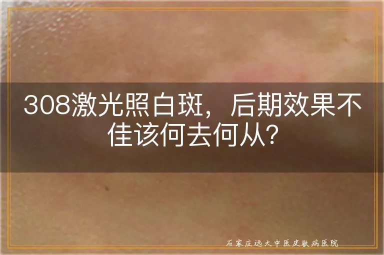 308激光照白斑，后期效果不佳该何去何从？