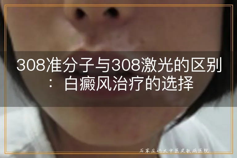 308准分子与308激光的区别：白癜风治疗的选择