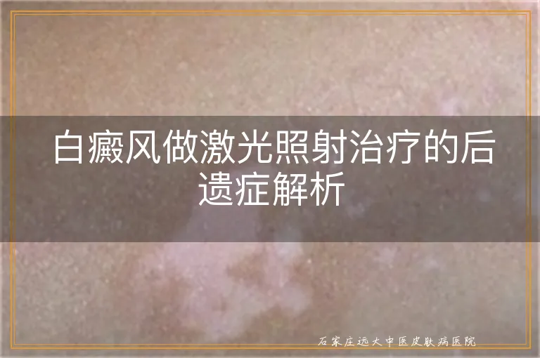 白癜风做激光照射治疗的后遗症解析