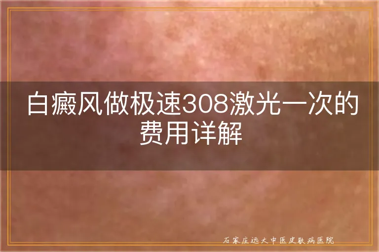 白癜风做极速308激光一次的费用详解