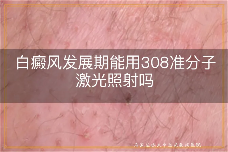 白癜风发展期能用308准分子激光照射吗