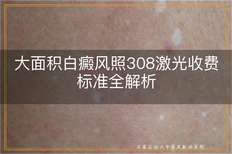 大面积白癜风照308激光收费标准全解析