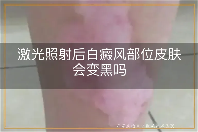 激光照射后白癜风部位皮肤会变黑吗