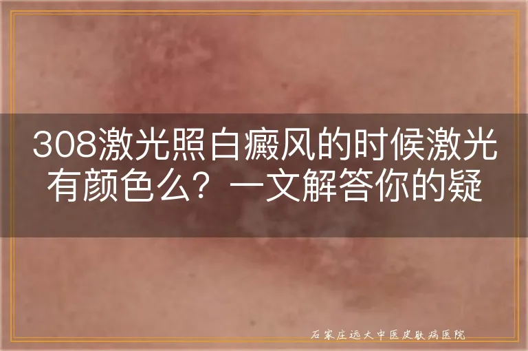 308激光照白癜风的时候激光有颜色么？一文解答你的疑惑