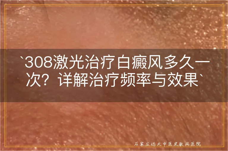 308激光治疗白癜风多久一次？详解治疗频率与效果