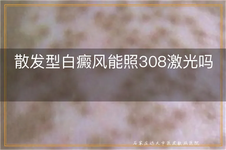 散发型白癜风能照308激光吗