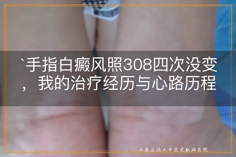 手指白癜风照308四次没变，我的治疗经历与心路历程