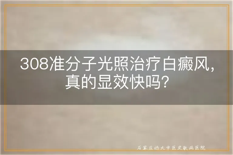 308准分子光照治疗白癜风，真的显效快吗？