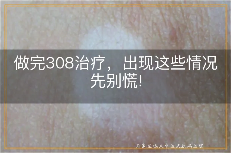 做完308治疗，出现这些情况先别慌!