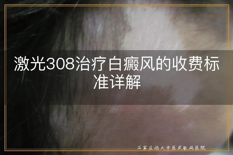 激光308治疗白癜风的收费标准详解