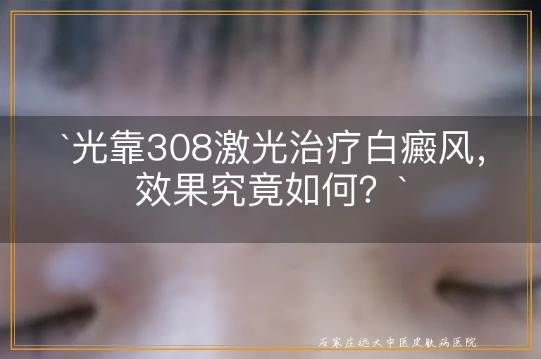 光靠308激光治疗白癜风，效果究竟如何？