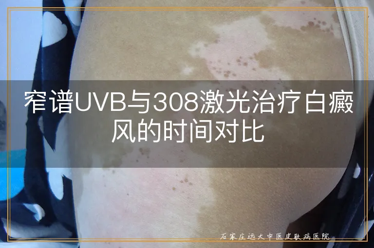 窄谱UVB与308激光治疗白癜风的时间对比