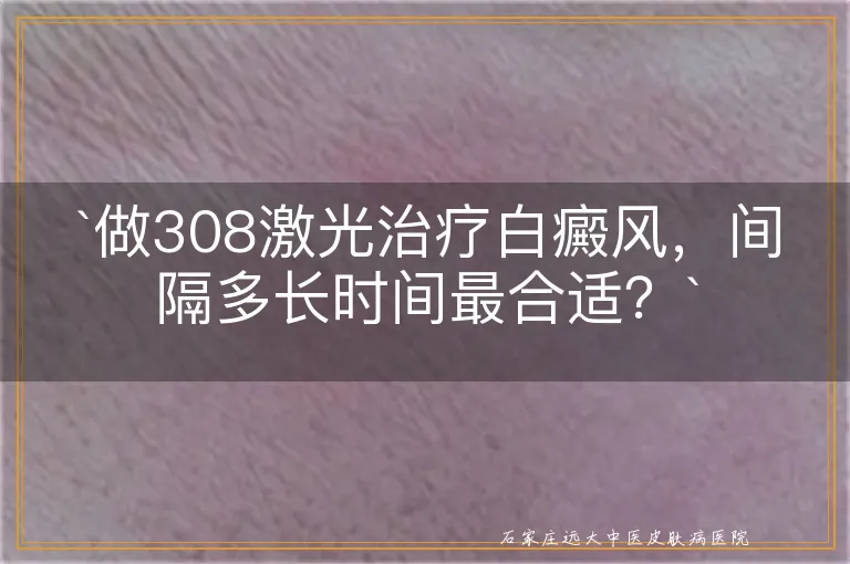 做308激光治疗白癜风，间隔多长时间最合适？