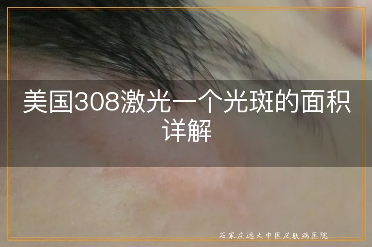 美国308激光一个光斑的面积详解