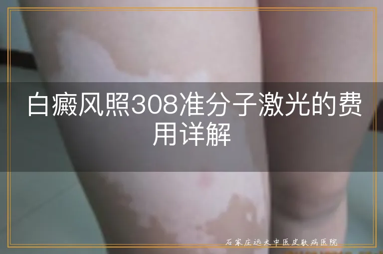 白癜风照308准分子激光的费用详解