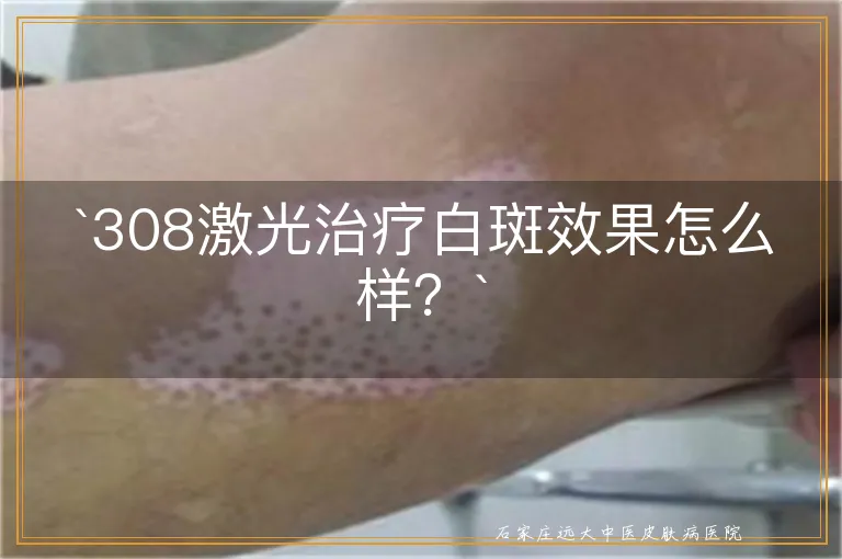 308激光治疗白斑效果怎么样？