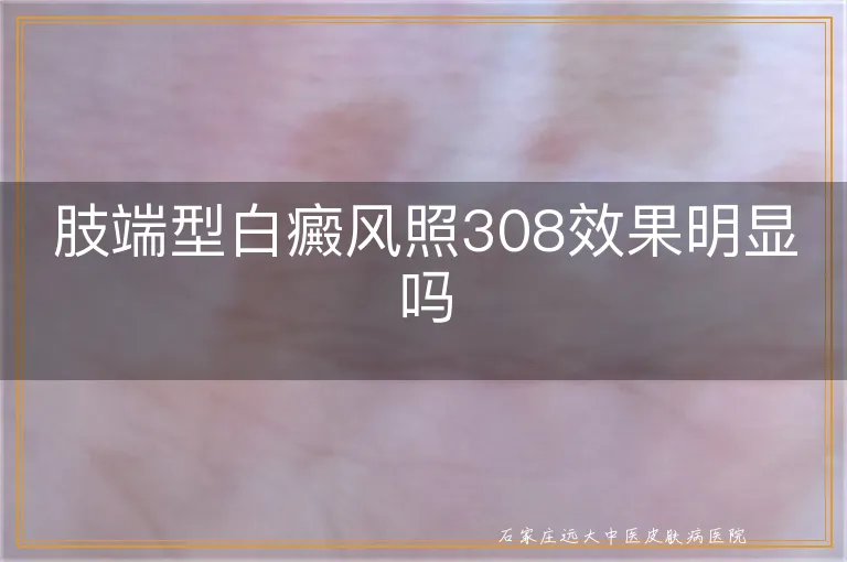 肢端型白癜风照308效果明显吗