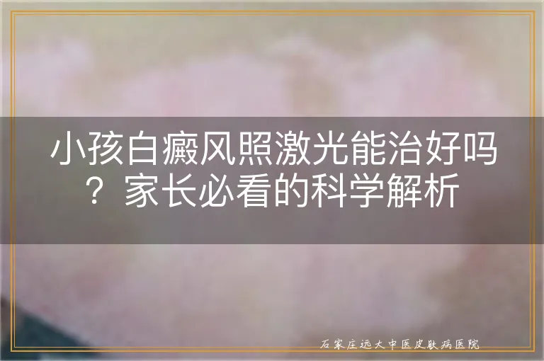 小孩白癜风照激光能治好吗？家长必看的科学解析