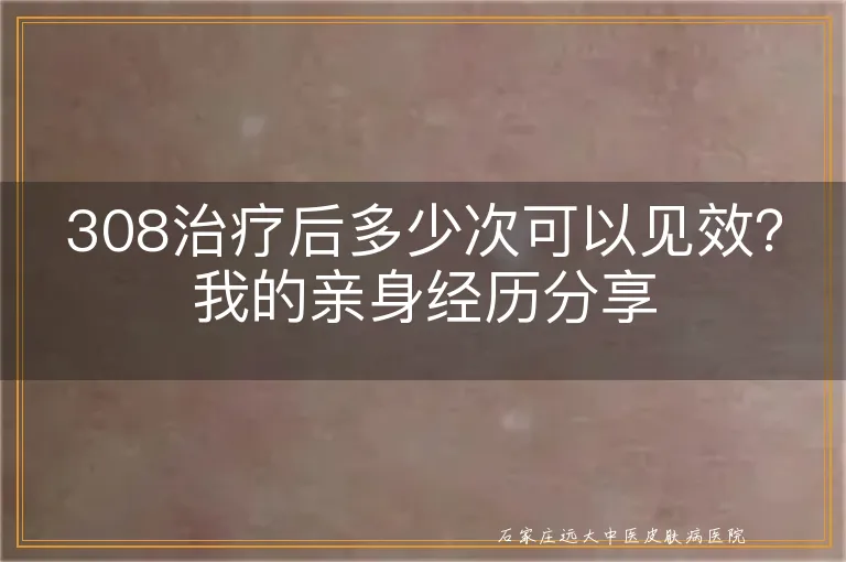 308治疗后多少次可以见效？我的亲身经历分享