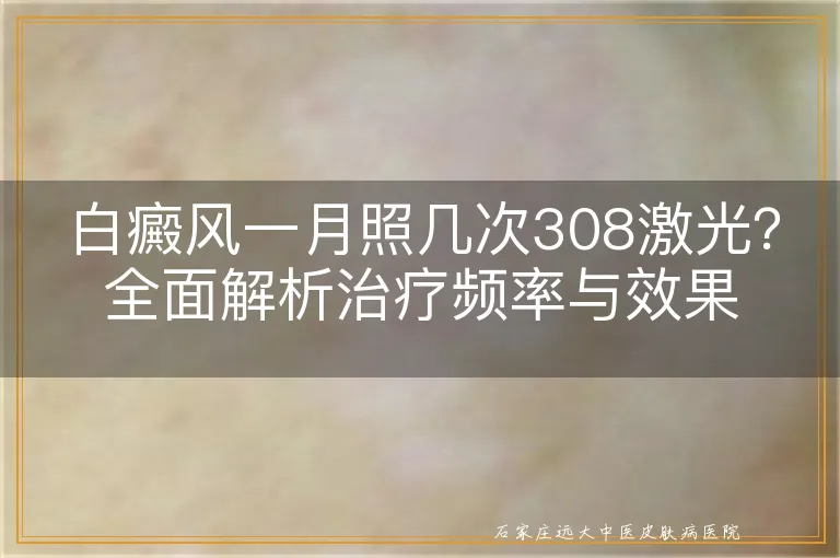 白癜风一月照几次308激光？全面解析治疗频率与效果