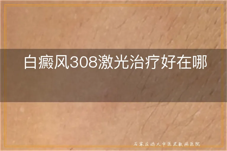 白癜风308激光治疗好在哪