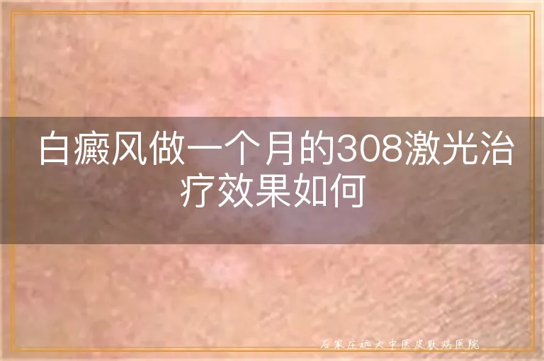 白癜风做一个月的308激光治疗效果如何