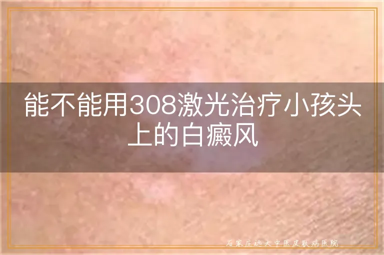 能不能用308激光治疗小孩头上的白癜风