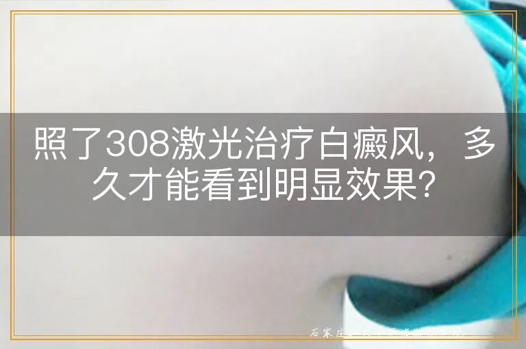 照了308激光治疗白癜风，多久才能看到明显效果？