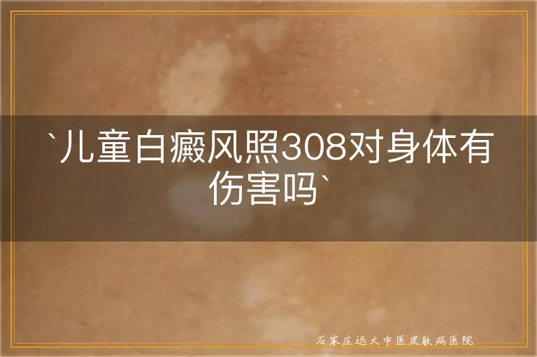 儿童白癜风照308对身体有伤害吗