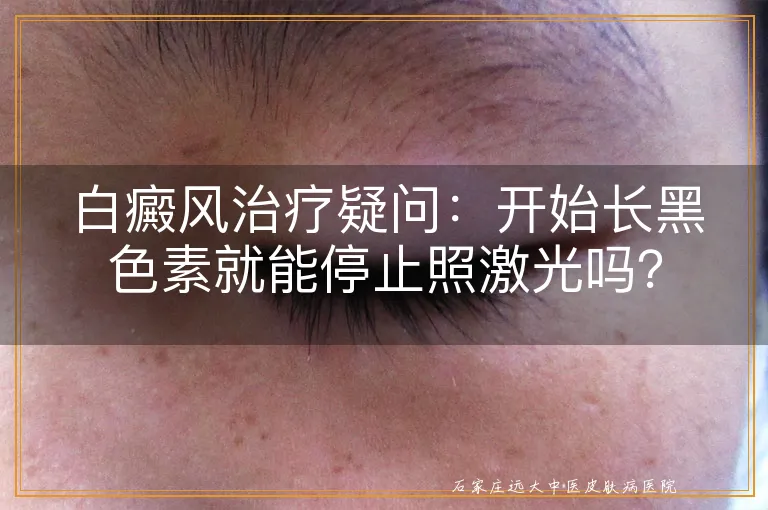 白癜风治疗疑问：开始长黑色素就能停止照激光吗？