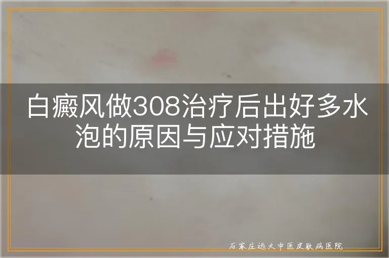 白癜风做308治疗后出好多水泡的原因与应对措施