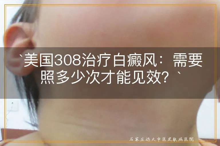 美国308治疗白癜风：需要照多少次才能见效？