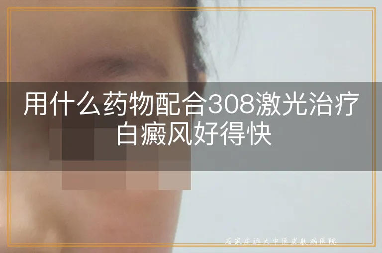 用什么药物配合308激光治疗白癜风好得快