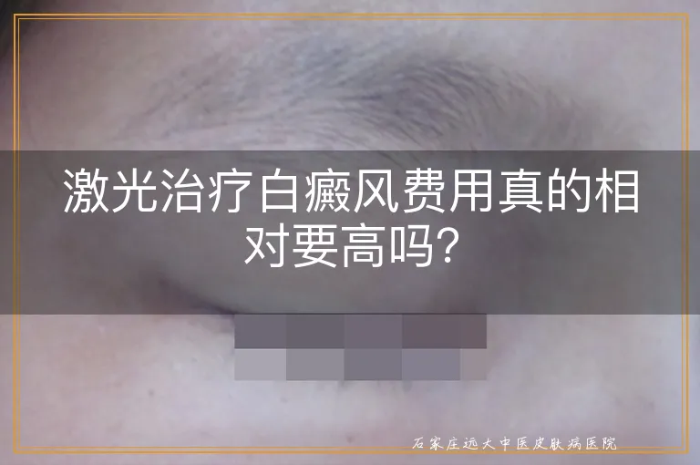 激光治疗白癜风费用真的相对要高吗？