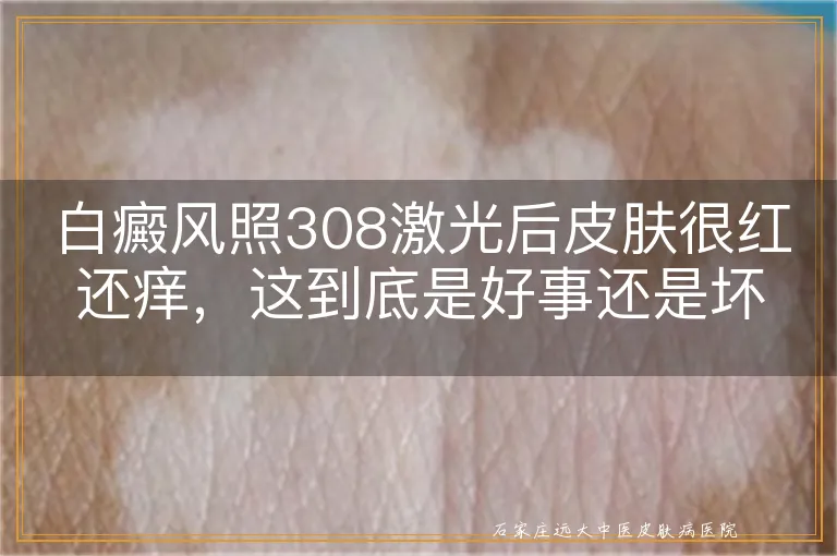 白癜风照308激光后皮肤很红还痒，这到底是好事还是坏事？