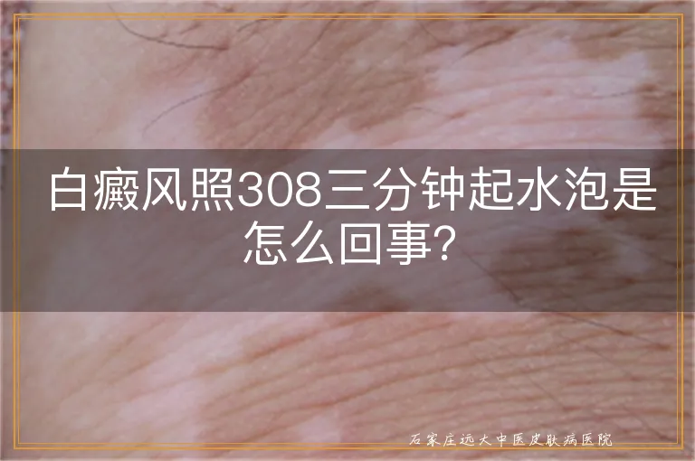 白癜风照308三分钟起水泡是怎么回事？