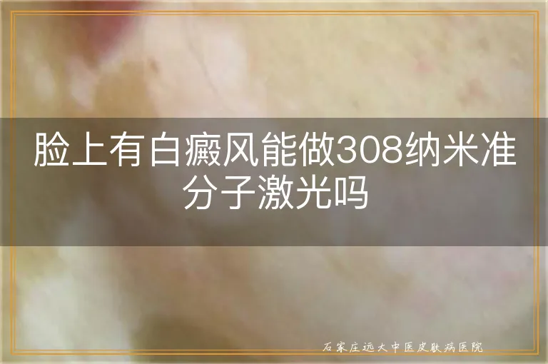 脸上有白癜风能做308纳米准分子激光吗