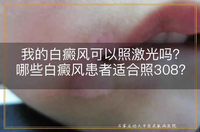 我的白癜风可以照激光吗？哪些白癜风患者适合照308？