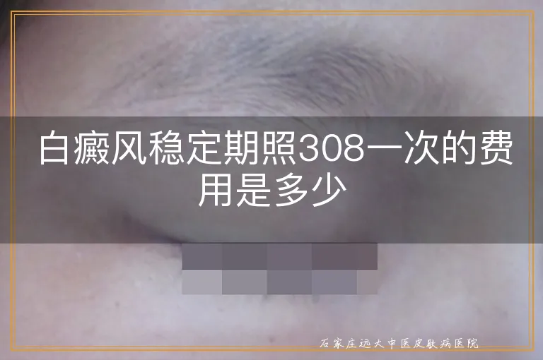 白癜风稳定期照308一次的费用是多少