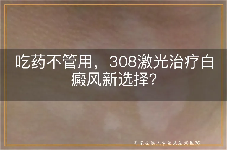 吃药不管用，308激光治疗白癜风新选择？