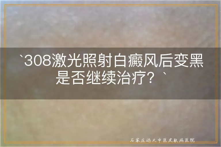 308激光照射白癜风后变黑是否继续治疗？